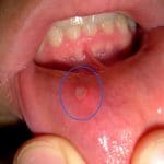 Stomatite : un remède efficace contre les infections buccale